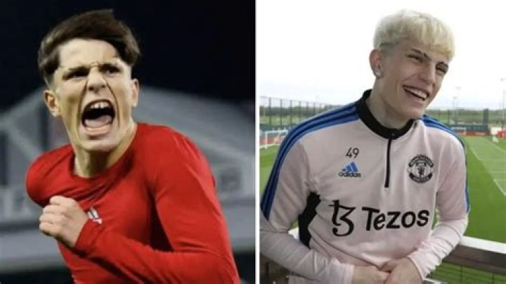 The Ultimate Guide To Garnacho's Face Surgery: Benefits, Risks, And Recovery