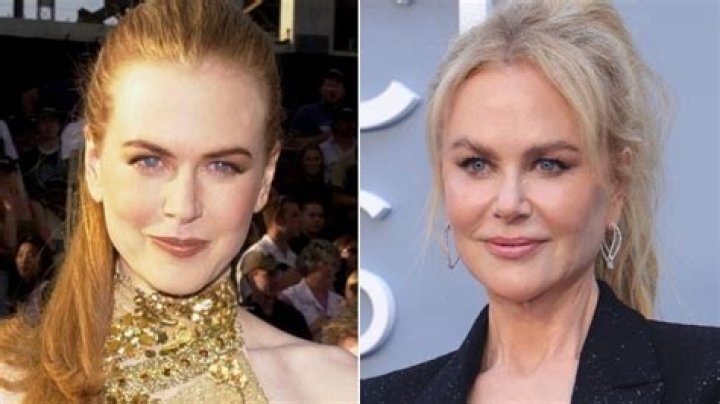 Expert Insights: Has Nicole Kidman Embraced Cosmetic Surgery Procedures?