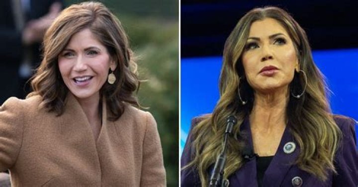 [BREAKING] Kristi Noem's Shocking Plastic Surgery Reveal