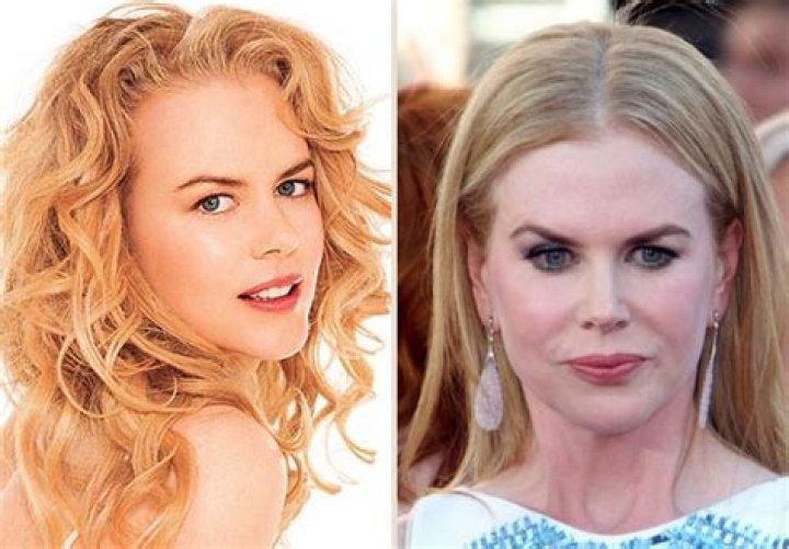 The Truth About Nicole Kidman's Breast Surgery: Unveiling The Facts