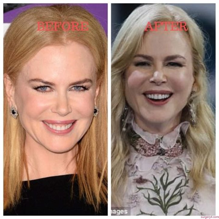 Nicole Kidman Plastic Surgery: A Comprehensive Guide To Her Procedures