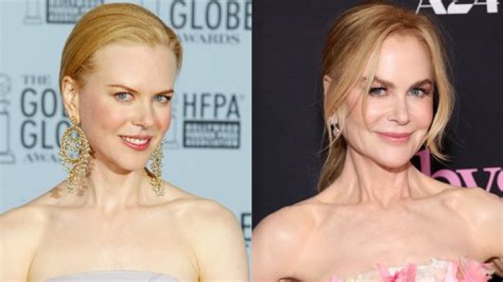Unveiling Nicole Kidman's Stunning Transformation: Plastic Surgery Enhancing Her Beauty