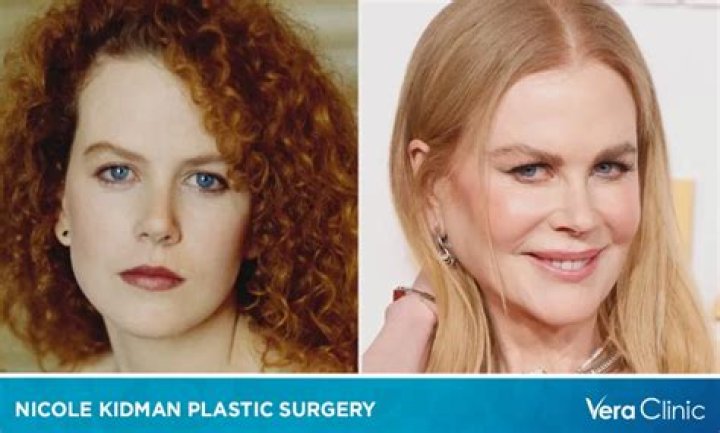 The Unveiled Truth: Nicole Kidman's Plastic Surgery Journey