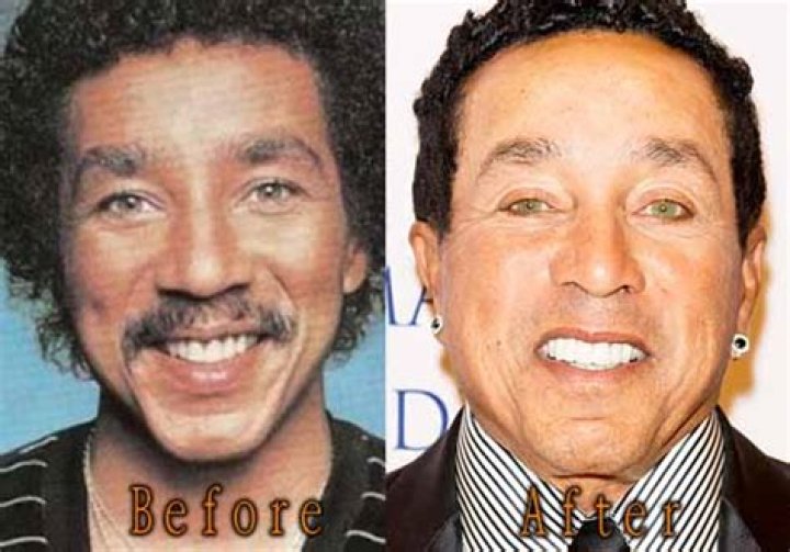 Unveiling The Truth About Smokey Robinson's Plastic Surgery Journey